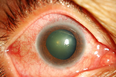 Luthina ลูทิน่า ดูแลระบบสายตา เพื่อการมองเห็นที่ดีขึ้น