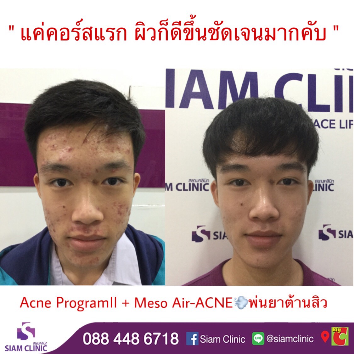 [E-Voucher] โปรแกรมรักษาปัญหาสิว 10 ขั้นตอน - Acne Program II