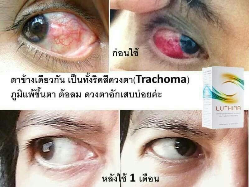 LUTHINA,ลูทิน่า,โรตตา,บำรุงสายตา,ต้อลม,ต้อหิน,ต้อกระจก,วุ้นในตาเสื่อม,การมองเห็น