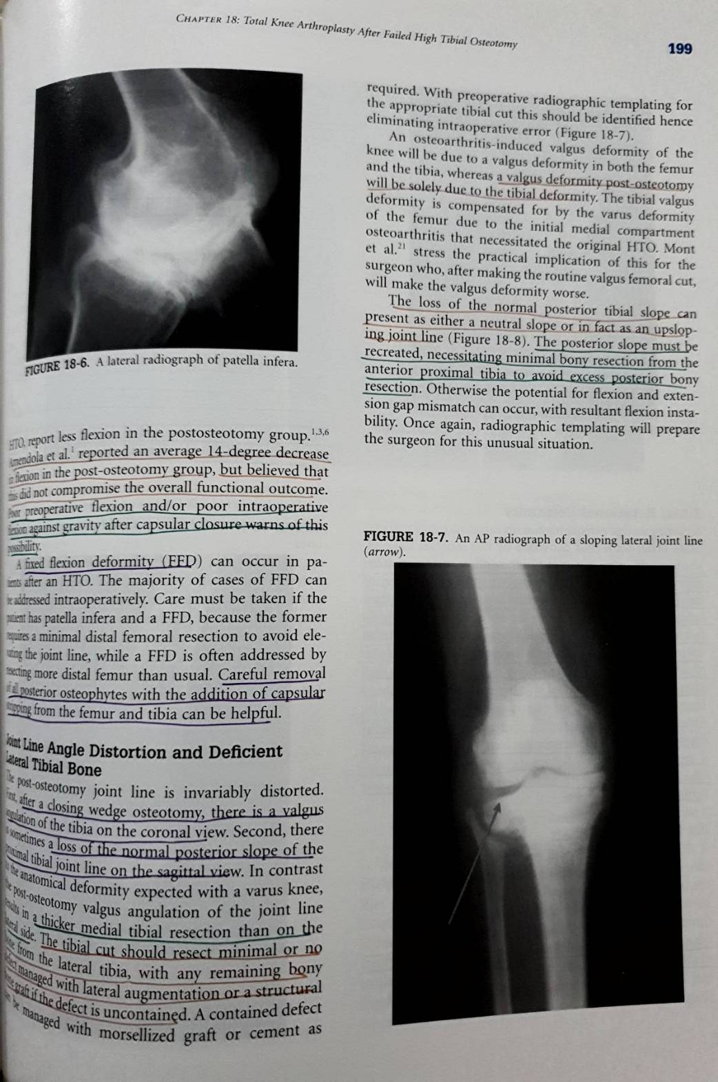 Revision Total Knee Arthroplasty : (Hardcover) James V. Bono