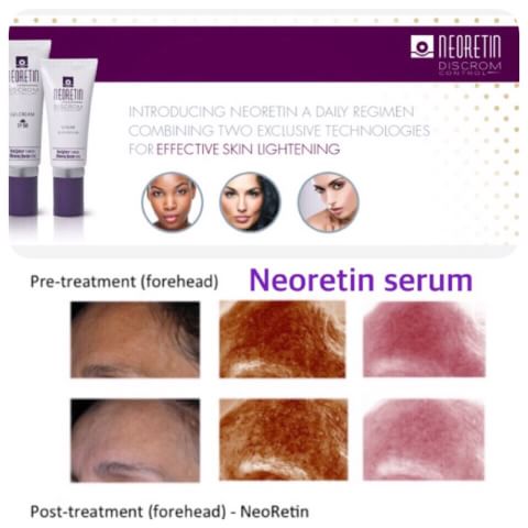 NEORETIN DISCROM CONTROL SERUM ขนาด 30 ml. ผิวขาวกระจ่างใส ฝ้า กระ จุดด่างดำลดเลือนลง