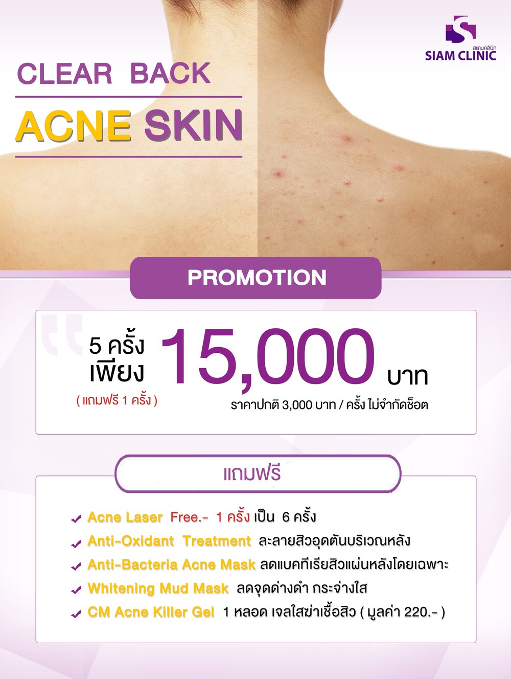 [E-Voucher] โปรแกรมเลเซอร์รักษาสิวหลัง รอยดำจากสิว - Laser