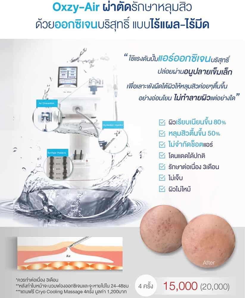 [E-Voucher] โปรแกรมรักษาหลุมสิวด้วยออกซิเจนบริสุทธิ์แบบไร้แผล ไร้มีด - Oxy Air