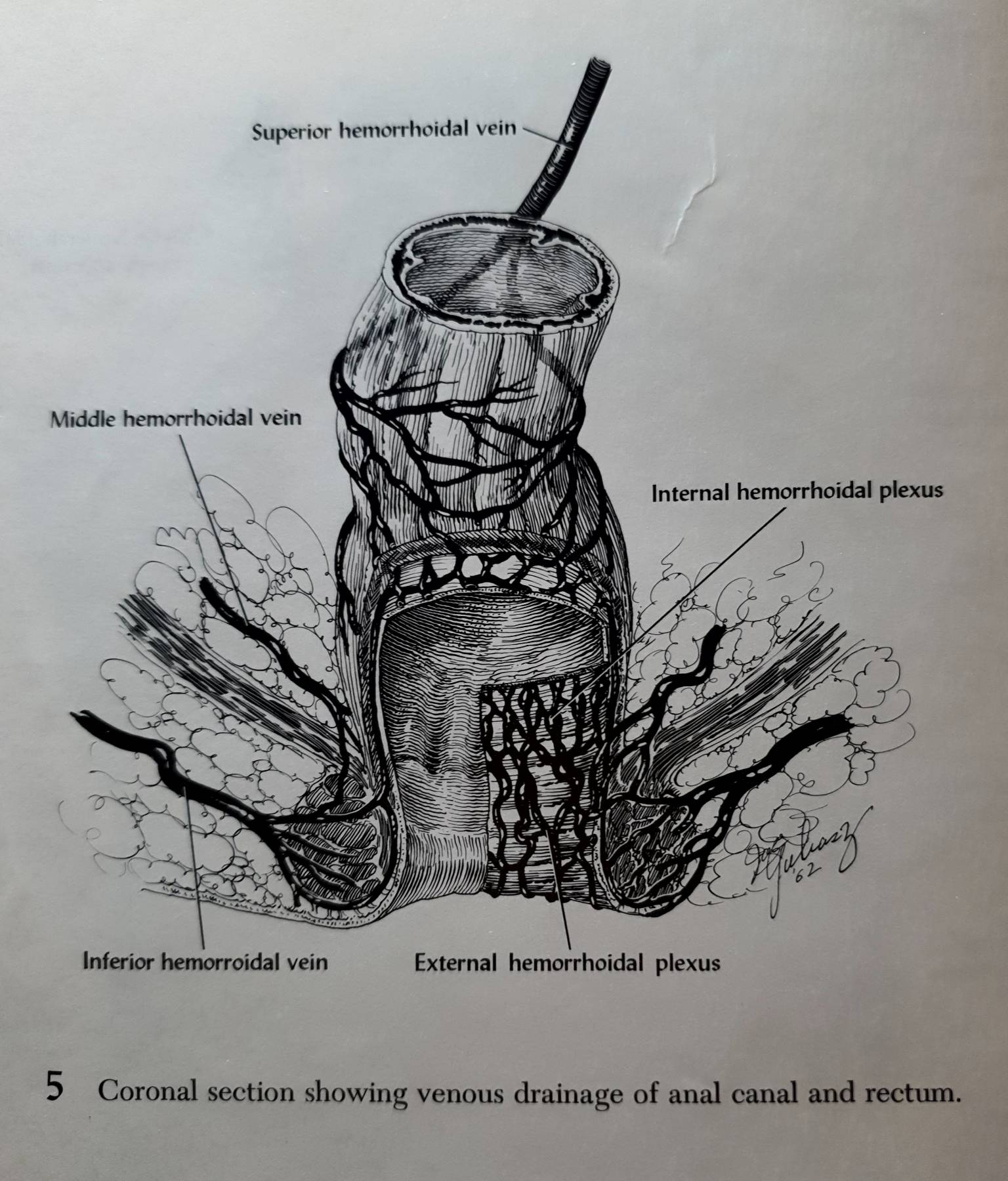 Atlas of Anorectal Surgery RICHARD A. LOCKWOOD, M.D. Illustrated by Joseph M. Yuhasz