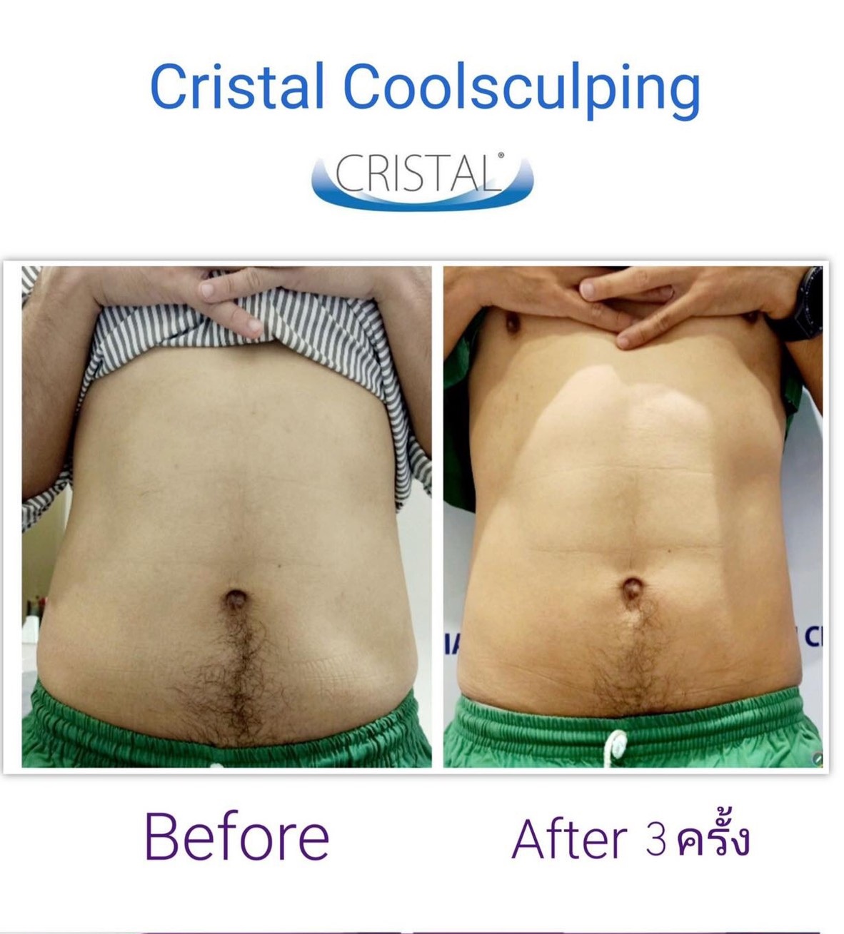 [E-Voucher] เครื่องลดไขมัน ด้วยความเย็นจุดเยือกแข็ง - CRISTAL COOL