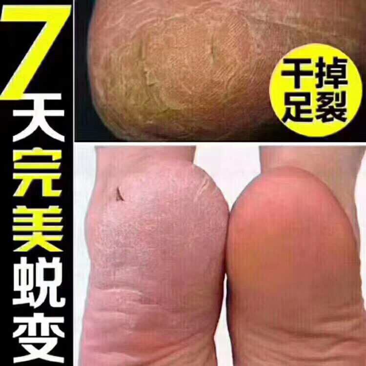 Banana Balm บำรุงส้นเท้าแตก 泰国香蕉膏 天气凉了 泰国皇冠牌香蕉滋润膏