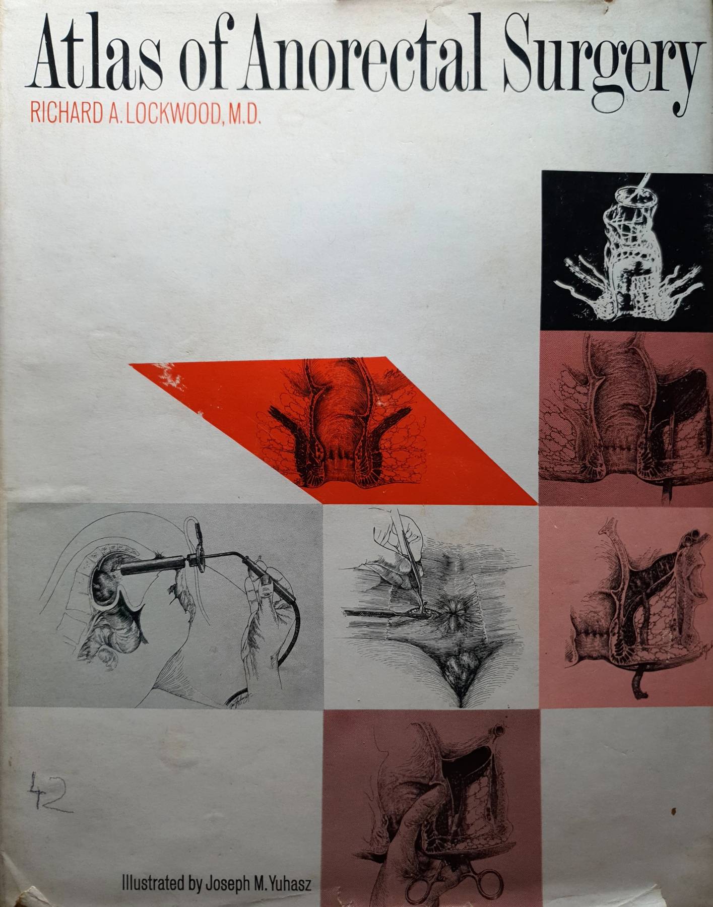 Atlas of Anorectal Surgery RICHARD A. LOCKWOOD, M.D. Illustrated by Joseph M. Yuhasz
