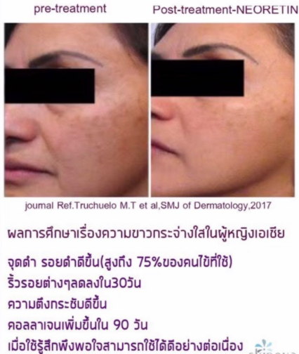 NEORETIN DISCROM CONTROL SERUM ขนาด 30 ml. ผิวขาวกระจ่างใส ฝ้า กระ จุดด่างดำลดเลือนลง