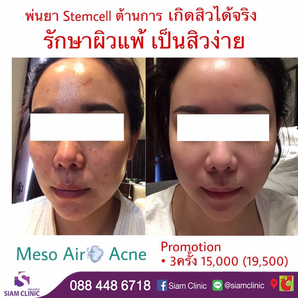 [E-Voucher] โปรแกรมรักษาปัญหาสิว 10 ขั้นตอน - Acne Program II