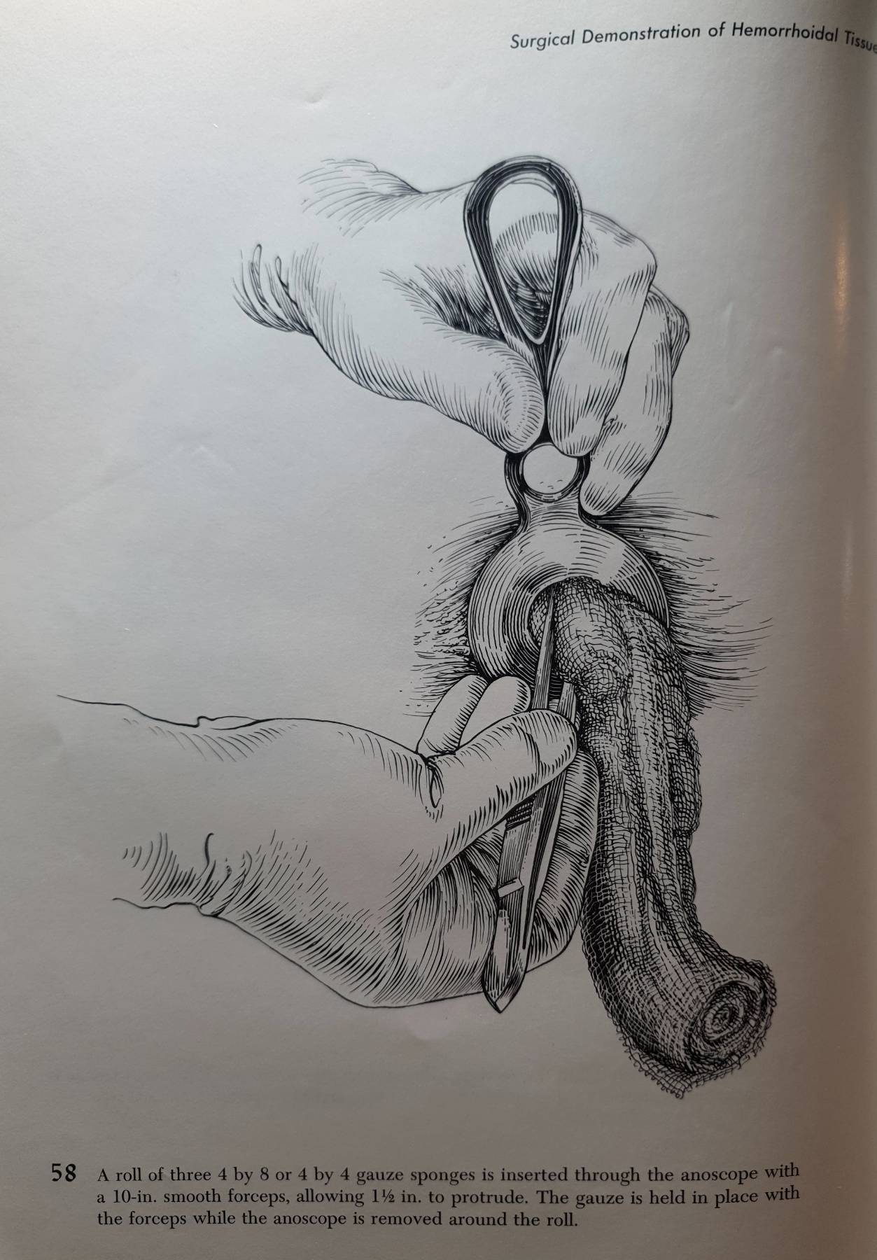 Atlas of Anorectal Surgery RICHARD A. LOCKWOOD, M.D. Illustrated by Joseph M. Yuhasz