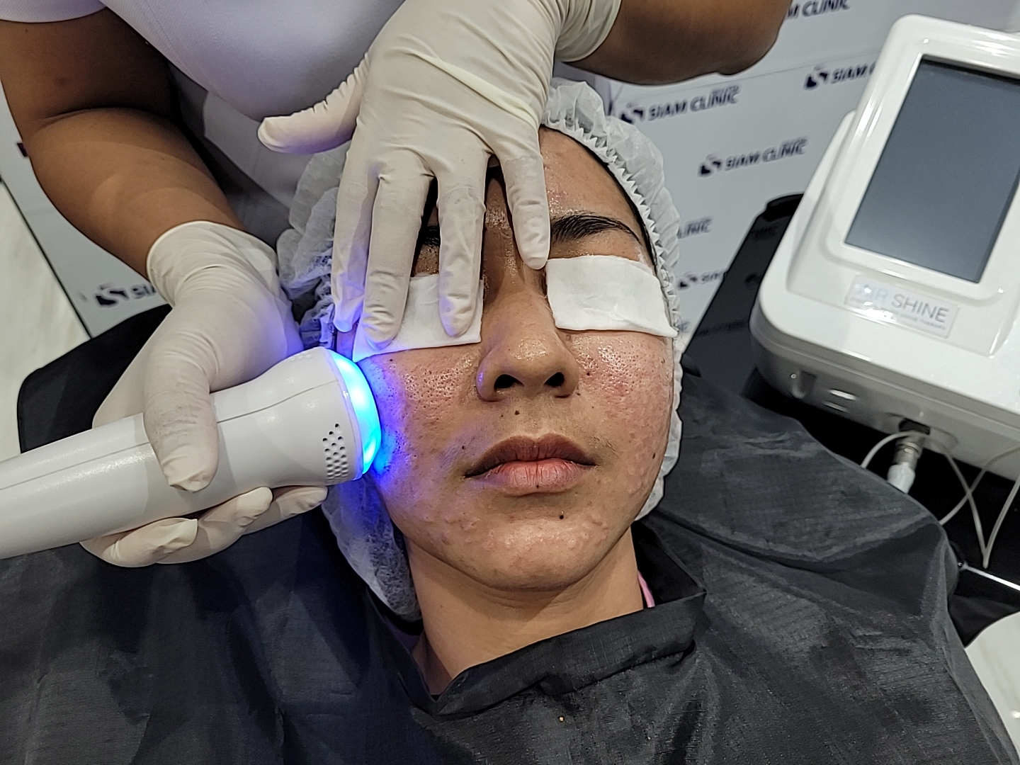 [E-Voucher] โปรแกรมรักษาหลุมสิวด้วยออกซิเจนบริสุทธิ์แบบไร้แผล ไร้มีด - Oxy Air