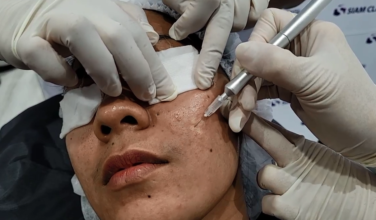 [E-Voucher] โปรแกรมรักษาหลุมสิวด้วยออกซิเจนบริสุทธิ์แบบไร้แผล ไร้มีด - Oxy Air