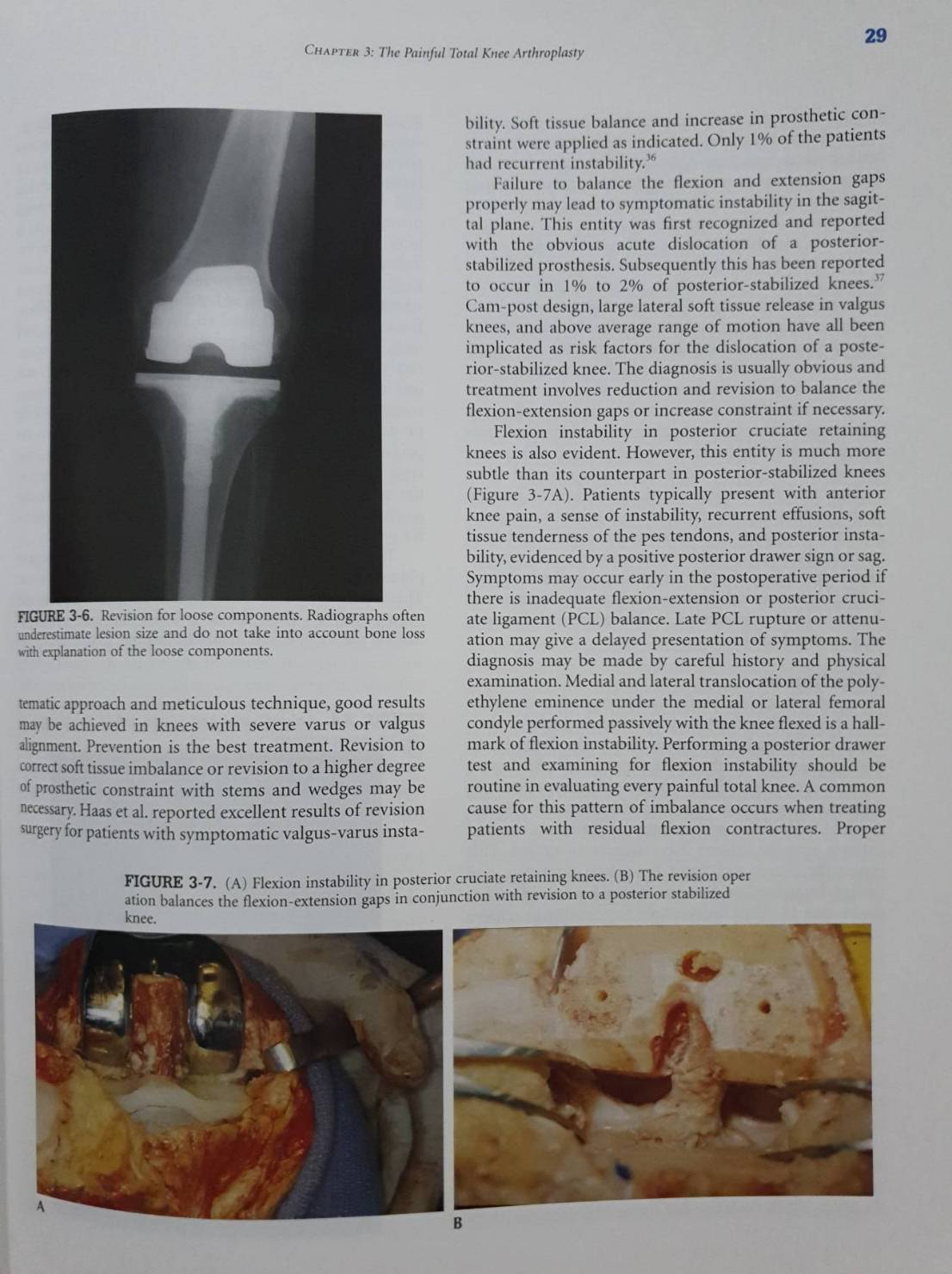 Revision Total Knee Arthroplasty : (Hardcover) James V. Bono