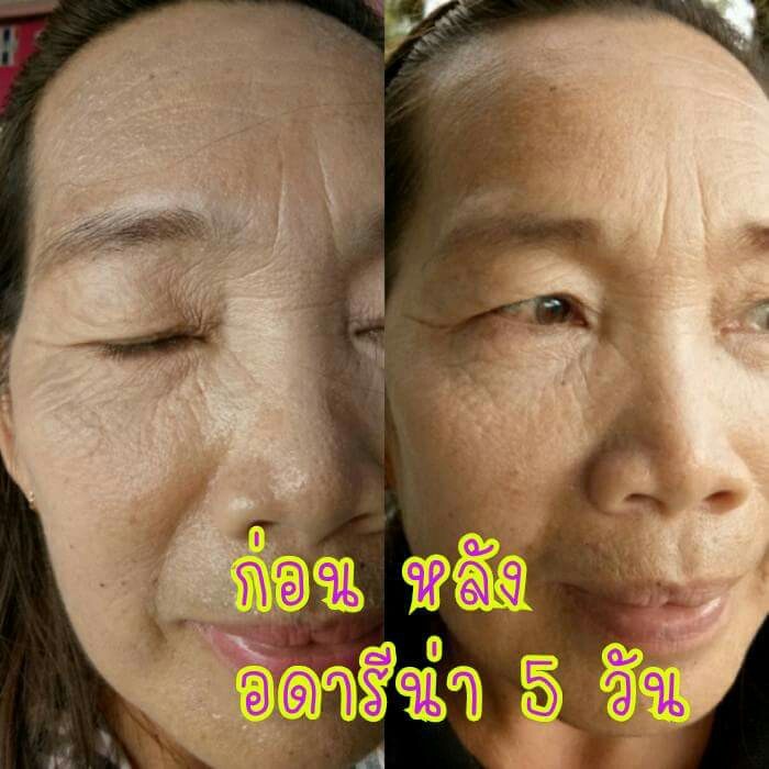 ADALINA,adalina stemcell,อดาลีน่า สเต็มเซลล์,ผิวเด็ก,ผิวตึงกระชับ,ลดริ้วรอย,เหี่ยวย่น,ถุงใต้ตา,ขอบตาดำ Adalina (อดาลีน่า)