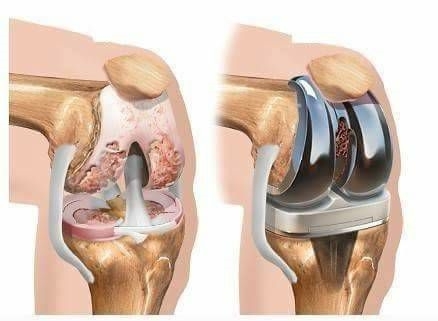 OSTO (ออสโต้) ดูแลและรักษา ข้อต่อและกระดูก